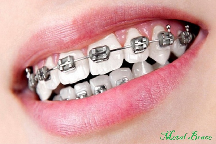 braces1