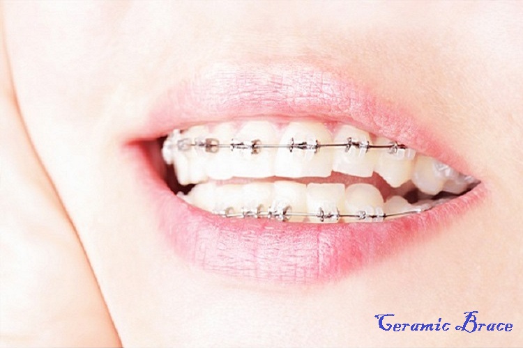 braces2