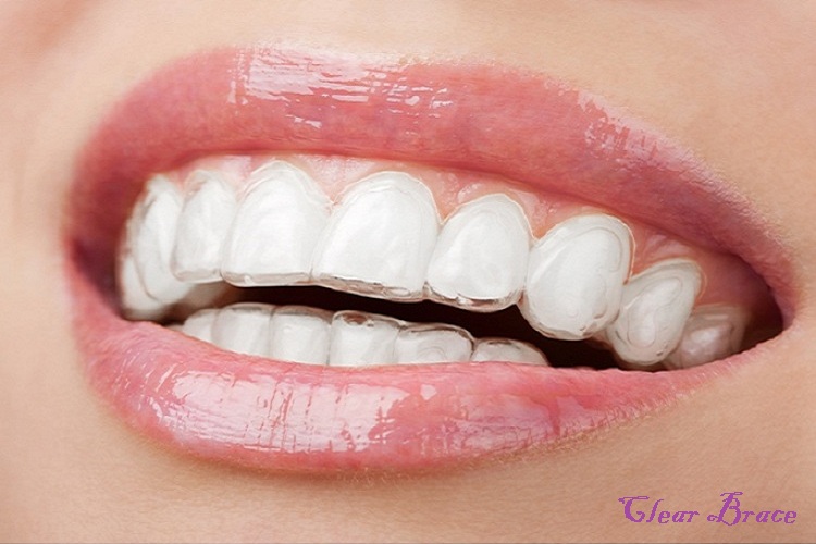 braces3