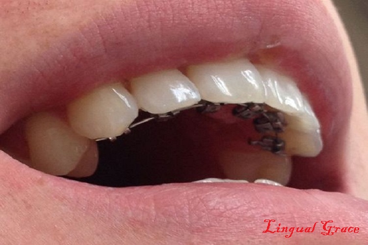 braces4
