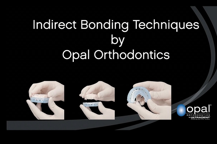 Indirect Bonding3
