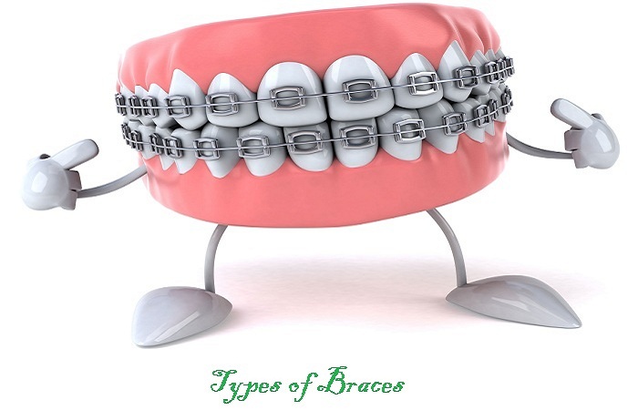 Types of Braces